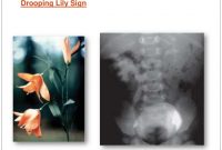 Development Of Urinary System And Congenital Anomalies Of in size 1024 X 768