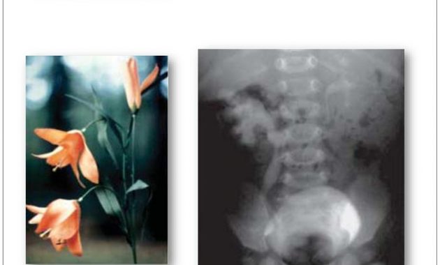 Development Of Urinary System And Congenital Anomalies Of in size 1024 X 768