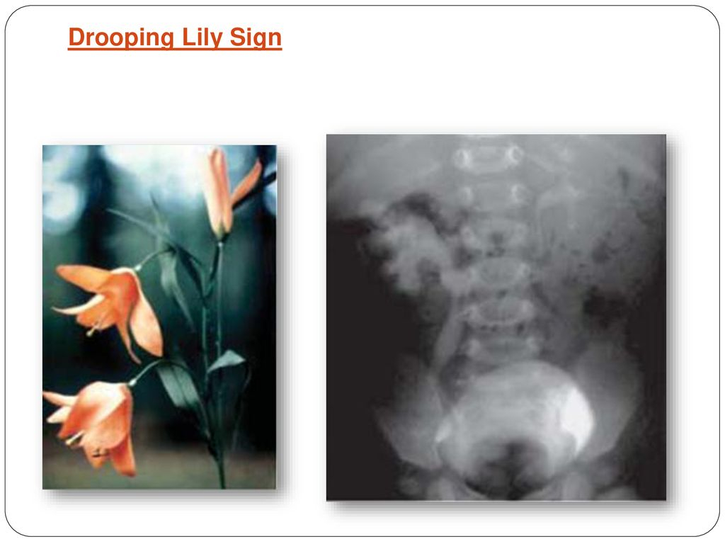 Development Of Urinary System And Congenital Anomalies Of with proportions 1024 X 768