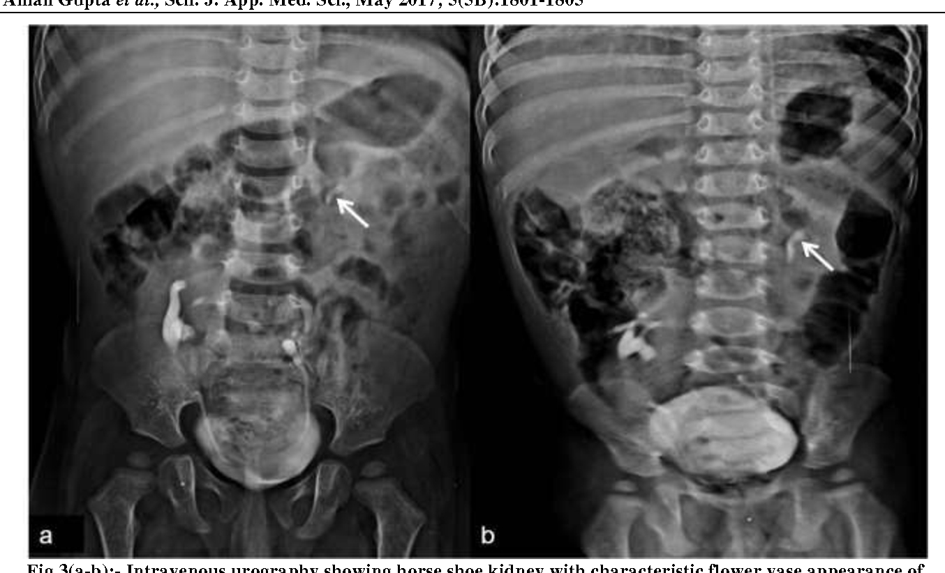 Figure 3 From Supernumerary Kidney In Conjunction With regarding dimensions 1354 X 822